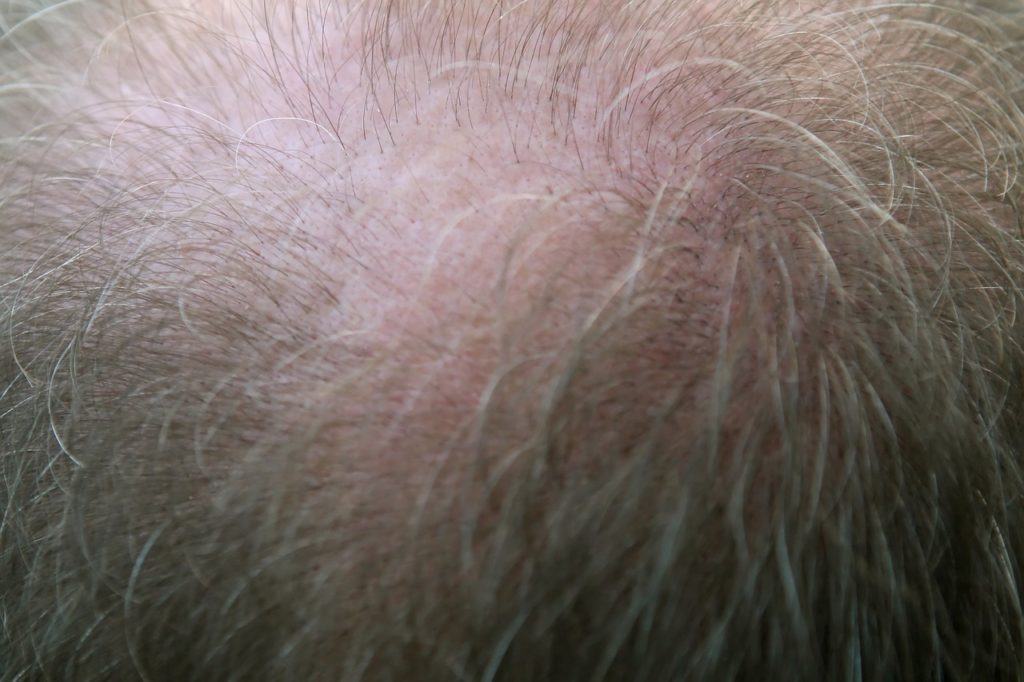 Bald spot over forehead 