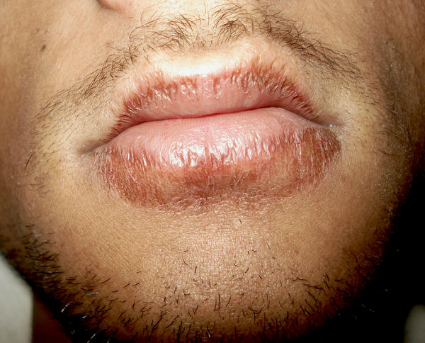 Dry-lips