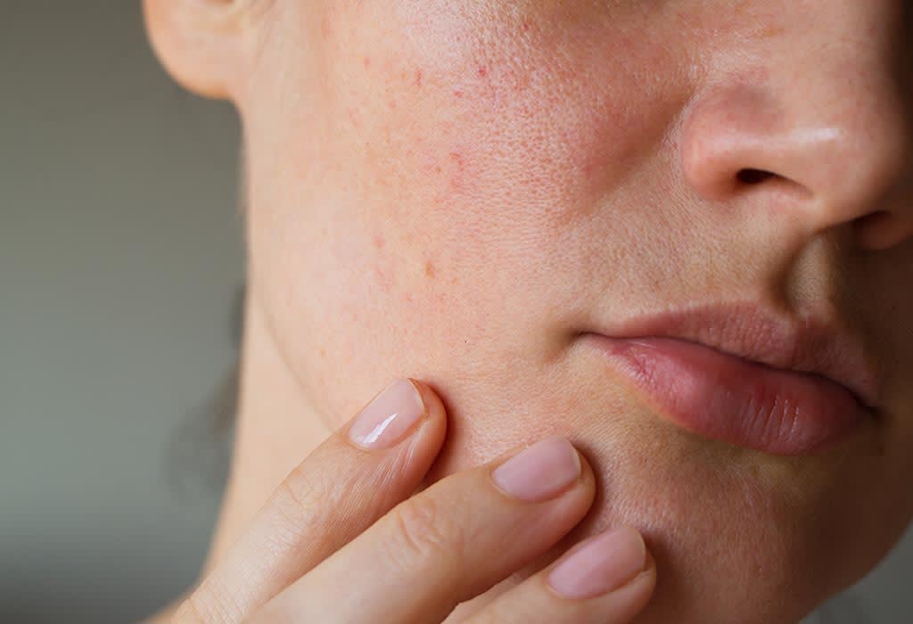 Causes of Open Pores